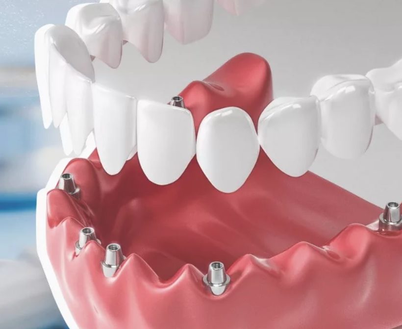 Имплантация зубов ALL-ON-6